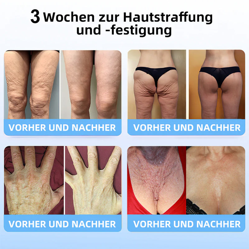 📒Flysmus® Hautstraffende Creme, Adressierung Krepp & Sagging