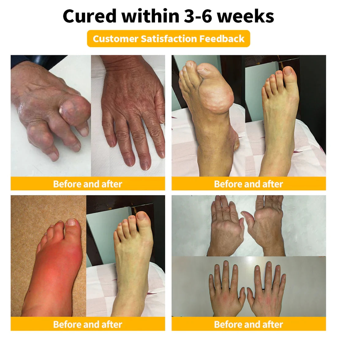 đŒđ„FurzeroâąBienengift Schmerz- und Knochenheilungscreme (Besonders geeignet fĂŒr Ă€ltere Menschen und zur Behandlung von Arthritis)