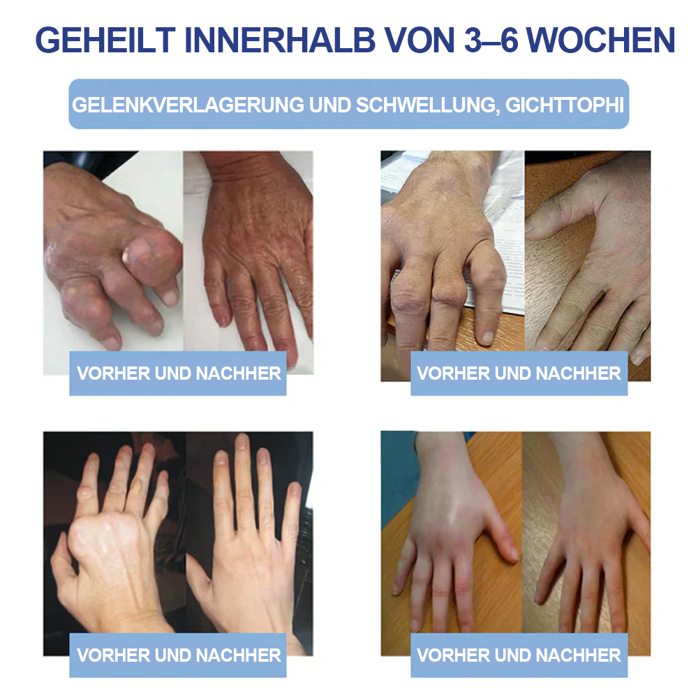 ✅Offizieller Store: Ourlyard® Magnesium Schmerzheilende Knochencreme (Behandlung für Arthritis, Neuropathie, rheumatische Erkrankungen, Muskelkrämpfe, Zuckungen und Sportverletzungen