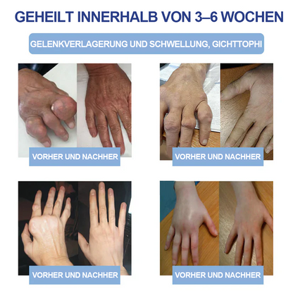 ✅Offizieller Store: Ourlyard® Magnesium Schmerzheilende Knochencreme (Behandlung für Arthritis, Neuropathie, rheumatische Erkrankungen, Muskelkrämpfe, Zuckungen und Sportverletzungen